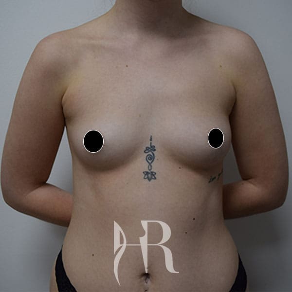 HR Plastic Surgery - Breast Enlargement patient before 6